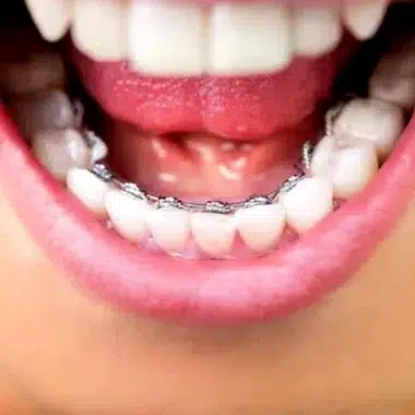 bonded retainers dn orthodontics