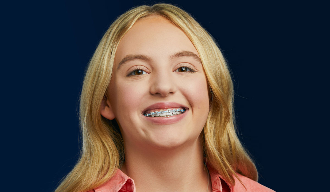 How to Maintain Oral Hygiene with Braces | DN Orthodontics