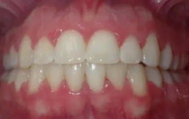 Brittany Smile Doctors Results DN Orthodontics