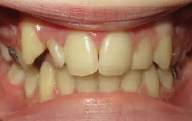 Alyssa Smile Doctors Results DN Orthodontics