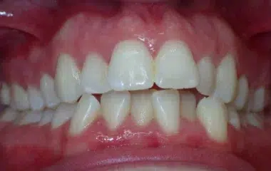 Brittany Smile Doctors Results DN Orthodontics