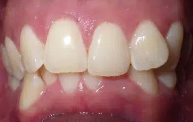 Corey Smile Doctors Results DN Orthodontics
