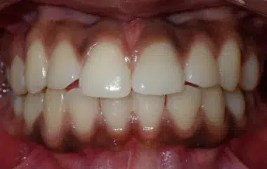 Danaria Smile Doctors Results DN Orthodontics